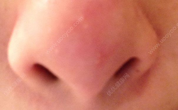 鼻梁上長痘痘是什么原因？鼻梁上長痘痘怎么消除？(4)