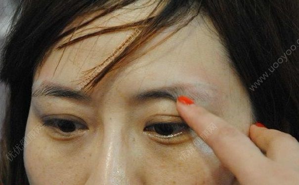 激光洗眉后紅印怎么樣淡化？激光洗眉后紅印怎么辦？(1)