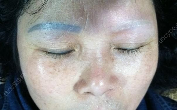 激光洗眉后眉毛還能長出來嗎？激光洗眉眉毛還會長嗎？(1)