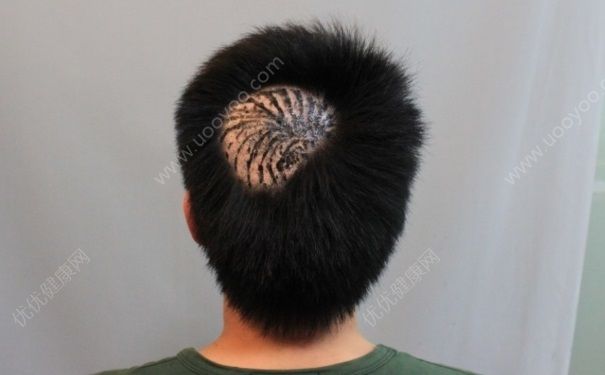 植發(fā)能解決脫發(fā)嗎？植發(fā)能維持多久？(1)