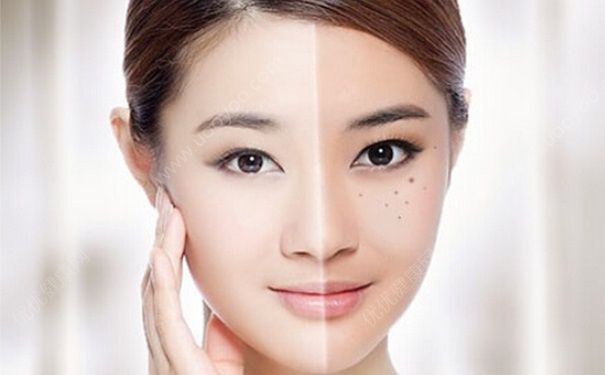 黃褐斑有哪些危害？黃褐斑如何治療？(1)