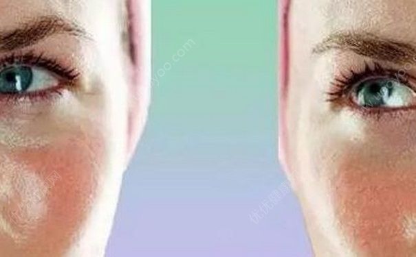 油性皮膚怎么護理？皮膚出油長痘怎么辦？(1)