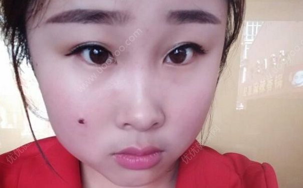 為什么臉上會(huì)長痣？什么原因讓臉上長痣？(5)