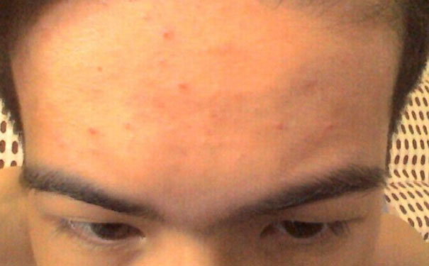 額頭油脂分泌旺盛怎么辦？額頭出油厲害怎么辦？(1)