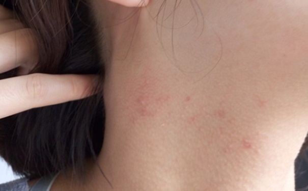 脖子上長痘痘是什么原因？脖子長痘痘是什么原因？(1)