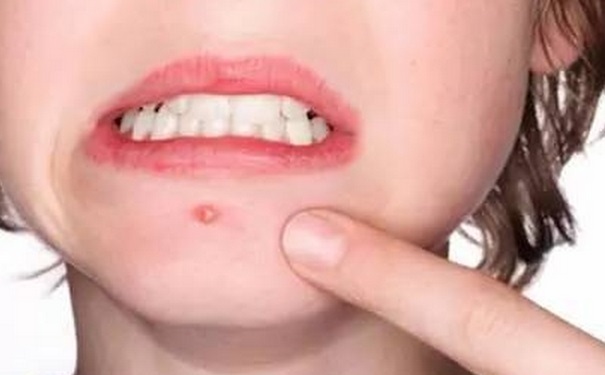 火氣大吃什么降火？火氣大不能吃什么？(1)