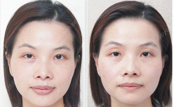 眼窩凹陷是哪些原因引起的？如何矯正眼窩凹陷？(1)