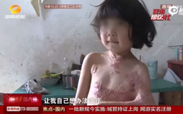 女孩燙傷成蝙蝠臂，燙傷后怎么辦？(1)