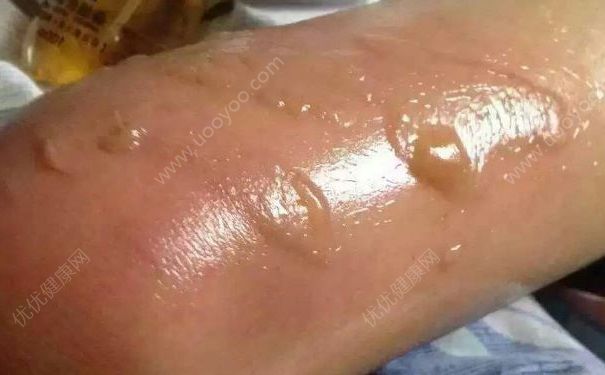 女孩燙傷成蝙蝠臂，燙傷后怎么辦？(3)
