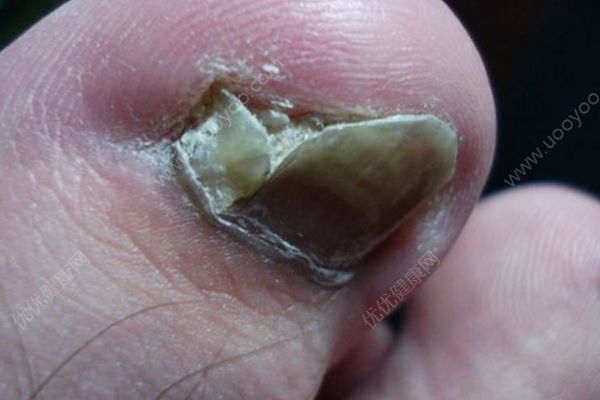 腳趾甲長肉里很痛怎么辦？這樣做幫你搞定(1)