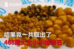 愛吃油炸長(zhǎng)468顆結(jié)石，油炸食品的危害有哪些？[多圖]