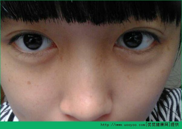 13歲臉上長(zhǎng)痘痘怎么辦？13歲臉上長(zhǎng)斑怎么辦？(3)