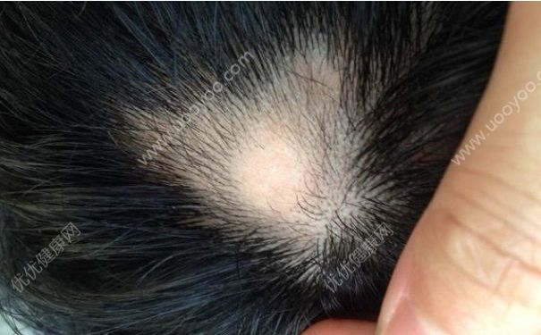 斑禿怎么治療？斑禿怎么治療比較好？(1)
