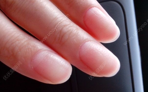 灰指甲治療有何有效偏方？預防灰指甲該怎么做？(1)