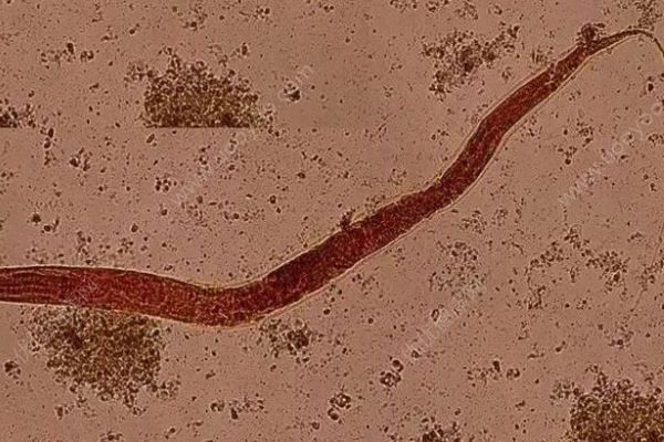 男子全身皮膚瘙癢竟是體內(nèi)長了蟲子！生食有哪些潛在危害(2)