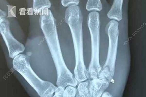 小伙看世界杯太激動(dòng)直拍桌子，手被拍骨折(1)