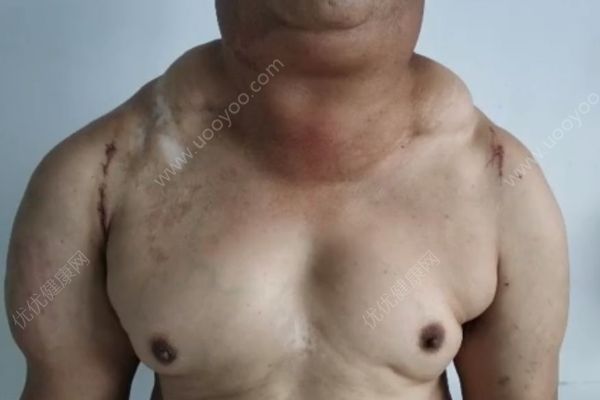 男子每天喝這東西，結(jié)果脖子變得和臉一樣大(1)