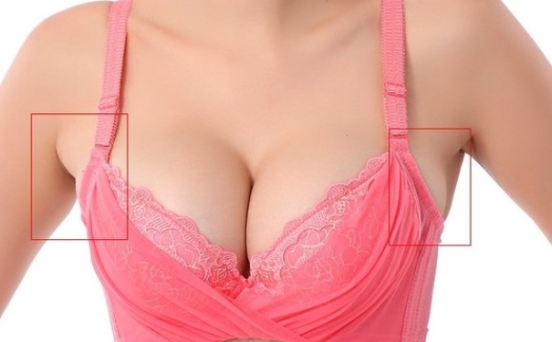 副乳怎么消除？副乳要怎么去掉？(1)