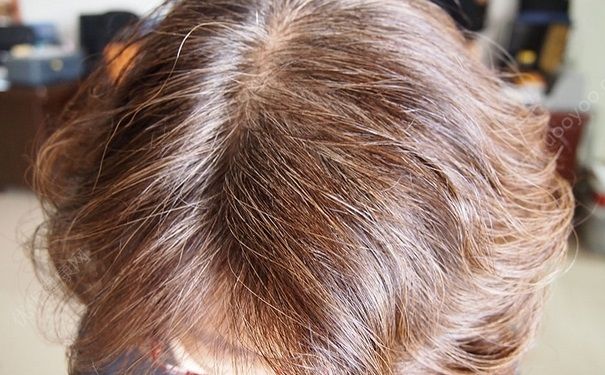 17歲吃黑芝麻能讓頭發(fā)變黑嗎？吃黑芝麻有什么功效？(2)