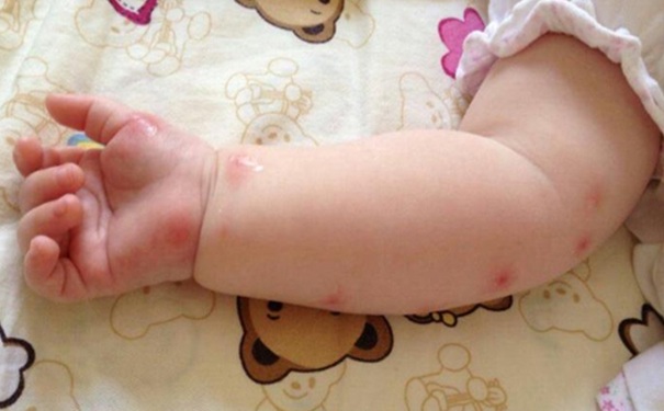 被蚊子咬了怎么消腫止癢？寶寶被蚊子咬了怎么消腫止癢？(1)