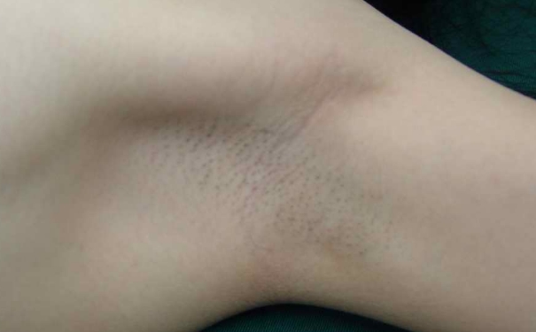 腋臭會遺傳下一代嗎？腋臭會遺傳嗎？(1)