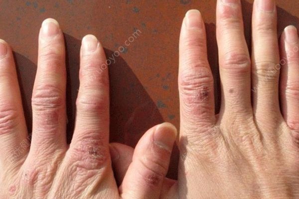 冬季手凍腫了怎么辦？冬季手凍了要這樣護(hù)理(1)