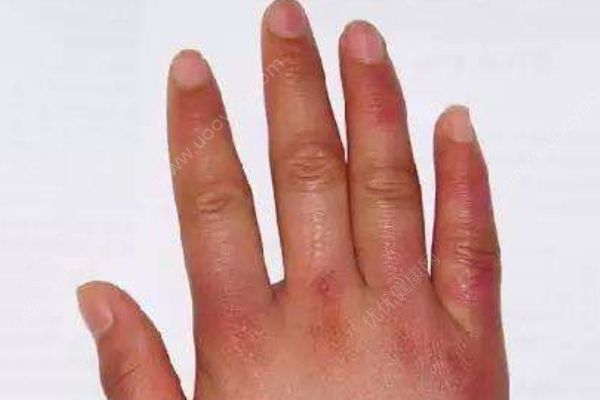如何才能告別蘿卜手？防治凍瘡有哪些小秘方？(1)