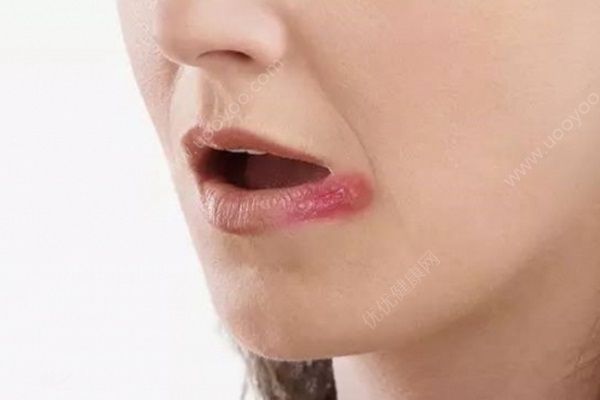 容易爛嘴角吃什么能治？爛嘴角要多吃這幾種食物(1)