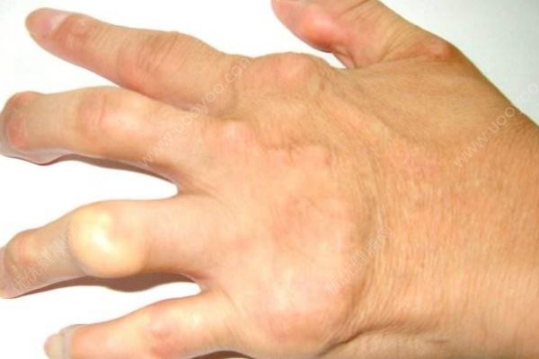 如何有效預(yù)防痛風(fēng)？將痛風(fēng)拒之門外的小妙招！(1)