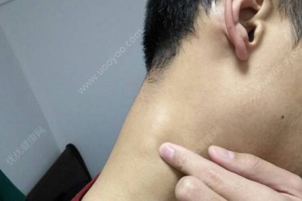 男子耳后長小疙瘩不在意，半年后變癌癥，皮下腫塊需警惕(3)