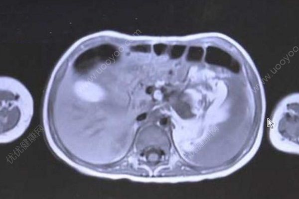 3歲女童腹腔長(zhǎng)直徑約15厘米腫瘤，幸好發(fā)現(xiàn)的早(1)