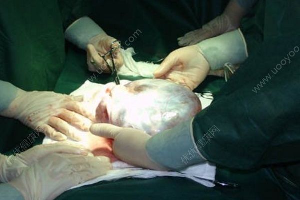 墨西哥少女腹部疼痛難忍，醫(yī)生取出15公斤重腫瘤(1)
