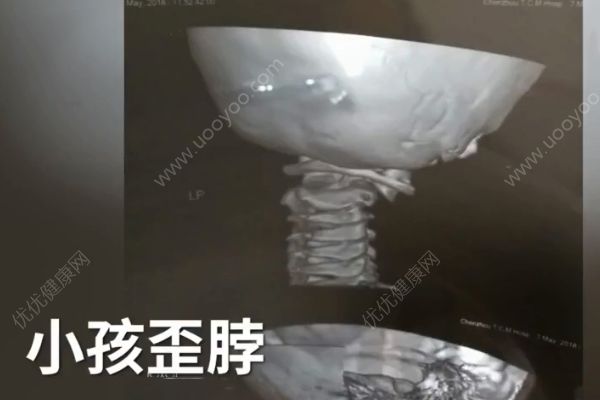 躺著玩手機(jī)太久，男童變歪頭寶寶！(2)