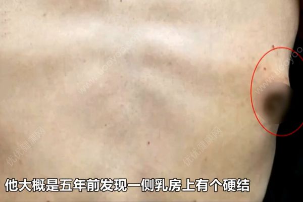 六旬老翁患上女人病！醫(yī)生說乳腺癌非女性專利！(3)