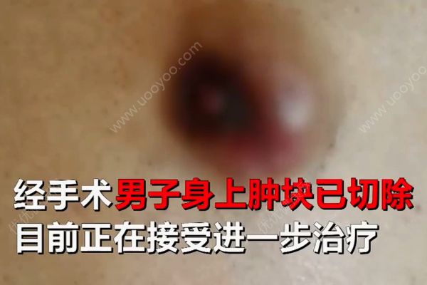六旬老翁患上女人病！醫(yī)生說乳腺癌非女性專利！(4)
