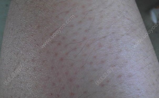 青少年可以用脫毛膏嗎？青少年汗毛多怎么辦？(1)