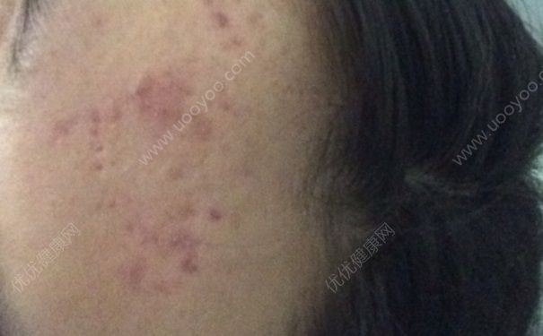 16歲臉上有痘印怎么辦？臉上有痘印怎么消除？(2)