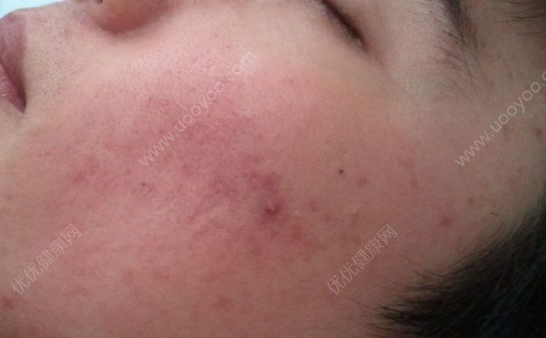 16歲臉上有痘印怎么辦？臉上有痘印怎么消除？(1)