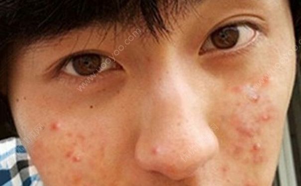 15歲男孩額頭長痘咋辦？15歲男孩臉上長痘怎么辦？(2)