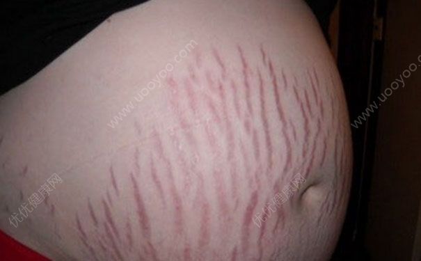 妊娠紋如何預防？妊娠紋如何去掉？(3)