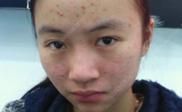 青春痘的治療方法有哪些？青春痘如何快速去除？(1)