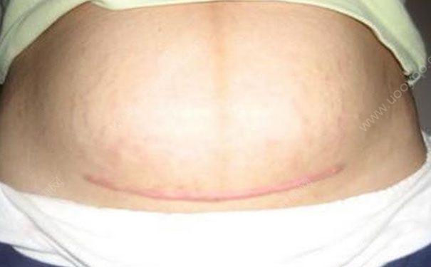 剖腹產(chǎn)疤痕能去掉嗎？剖腹產(chǎn)疤痕怎么去除？(1)