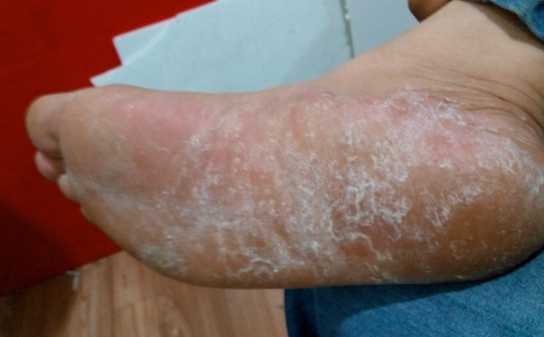 腳跟癢的厲害是怎么回事？腳跟癢是什么原因引起的？(1)