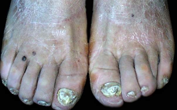腳趾甲變黑是什么原因？腳趾甲變黑是怎么回事？(1)