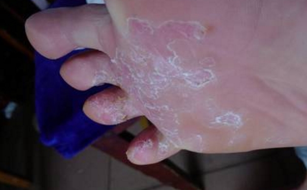 腳底干燥怎么辦？腳底干燥脫皮怎么辦？(1)