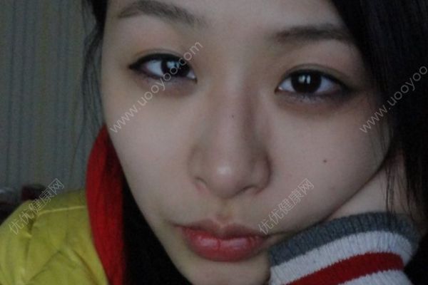 黑眼圈越來越重，可能是體內(nèi)有濕氣的表現(xiàn)(1)