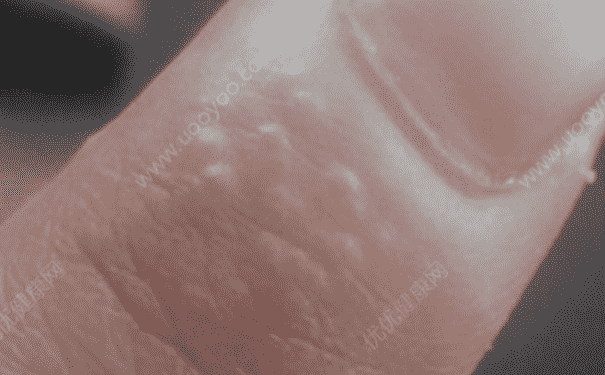 手上起小水泡癢是怎么回事？手上起小水泡癢怎么處理好？(1)