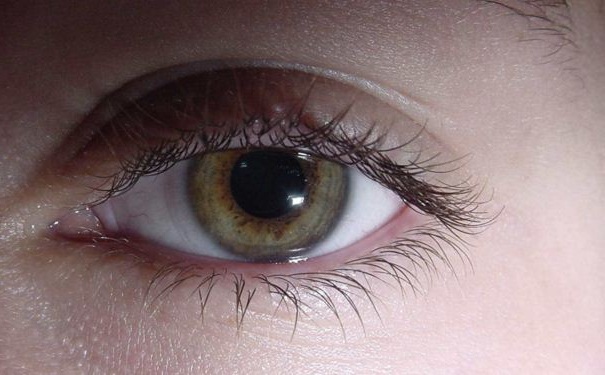 治療角膜炎要怎么做？角膜炎有何危害？(1)