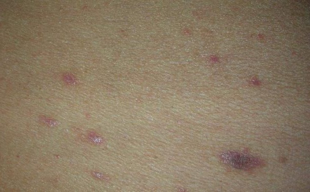 扁平苔蘚有何并發(fā)癥？扁平苔蘚有什么危害？(1)