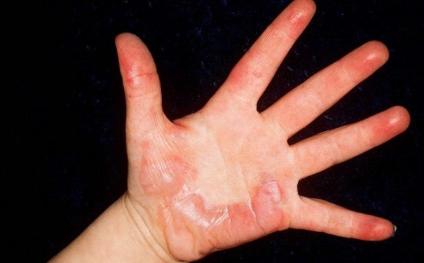 燒傷疤痕怎么護(hù)理？燒傷疤痕如何治療？(1)